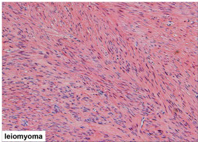 Time for Informed Consent: The FDA Considers Risks of Power Morcellators in Fibroid Surgery