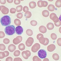 With So Many Terrific New Drugs For Chronic Lymphocytic Leukemia, Why Worry?