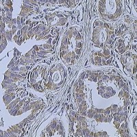 Perjeta Works In A Form Of Metastatic Breast Cancer: Active In Other Tumors?