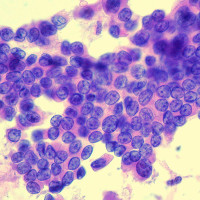 Why News About Thyroid Cancer Screening Doesn’t Apply To Breast Cancer