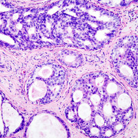 Why Women And Doctors Need To Know More About DCIS