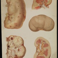 In A First, Kidney Cancer Drug Extends Survival