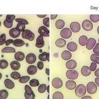 The Big News For Sickle Cell Anemia Is Not Gene Therapy