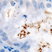 Can Antibiotics Prevent Deaths From Stomach Cancer?