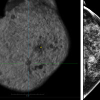 All Women Should Have Access To Ultrasound Screening For Breast Cancer