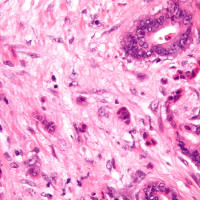 For Reasons Unknown, Colon And Rectal Cancer Rates Are Rising In People Under 50