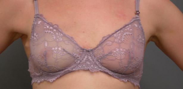 Plastic Surgery Is Not for Everyone: Options Following a Mastectomy