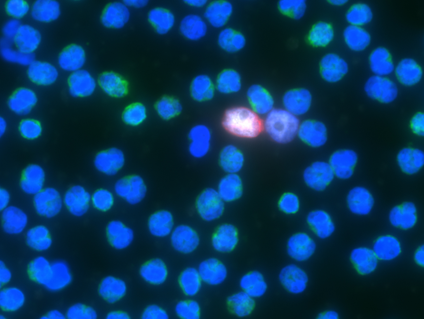 Blood Test Offers An Amazing View Of Metastatic Prostate Cancer Cells