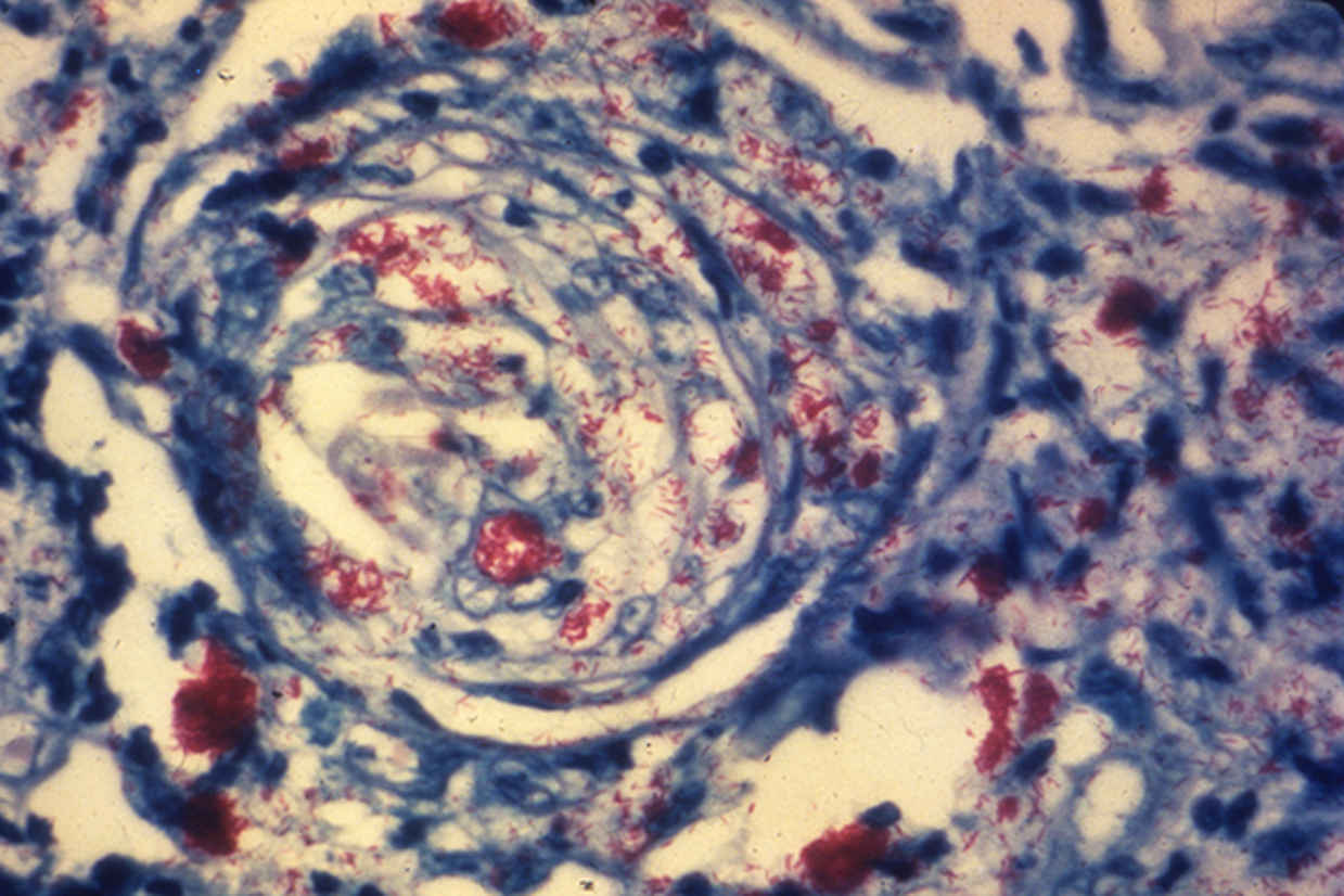 Leprosy: An Ancient Disease That Continues to Linger