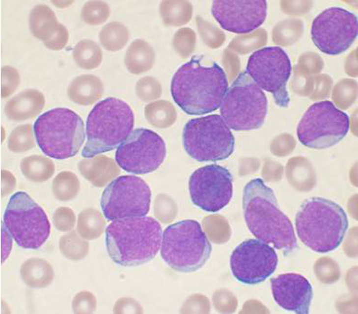 A New Antibody For Treating Acute Lymphocytic Leukemia?