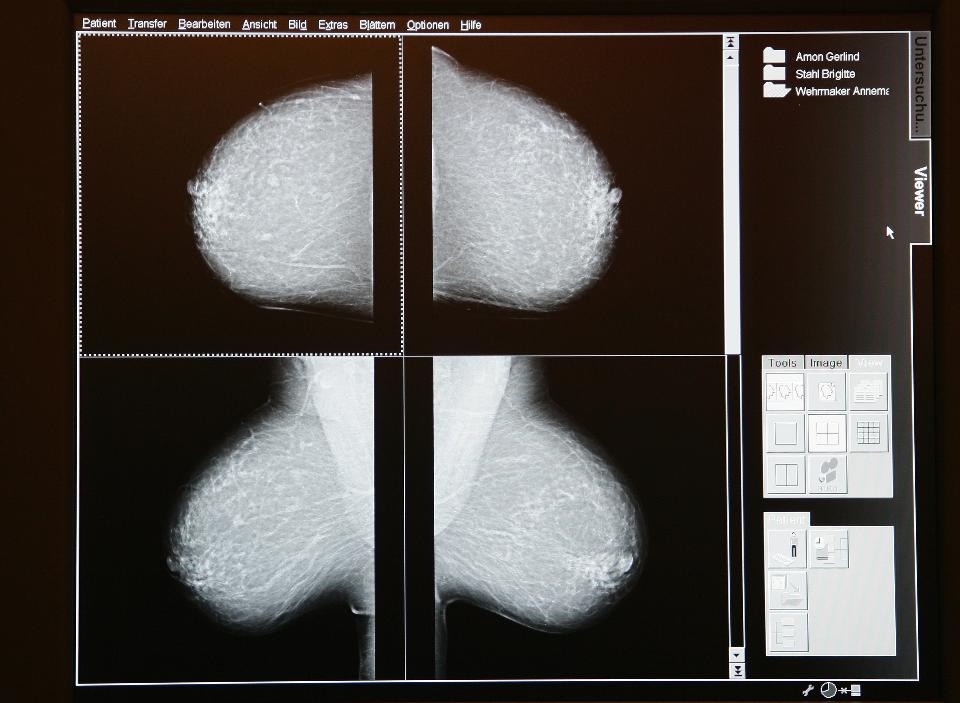 The Latest Study On Breast Cancer Overdiagnosis Fails To Persuade