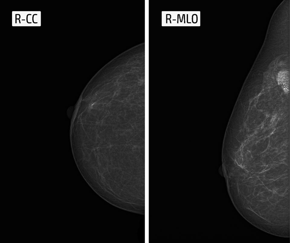 Debunking The Vanishing Breast Cancer Myth